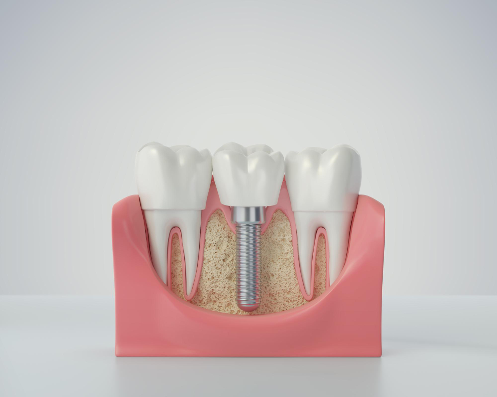 dental implants image