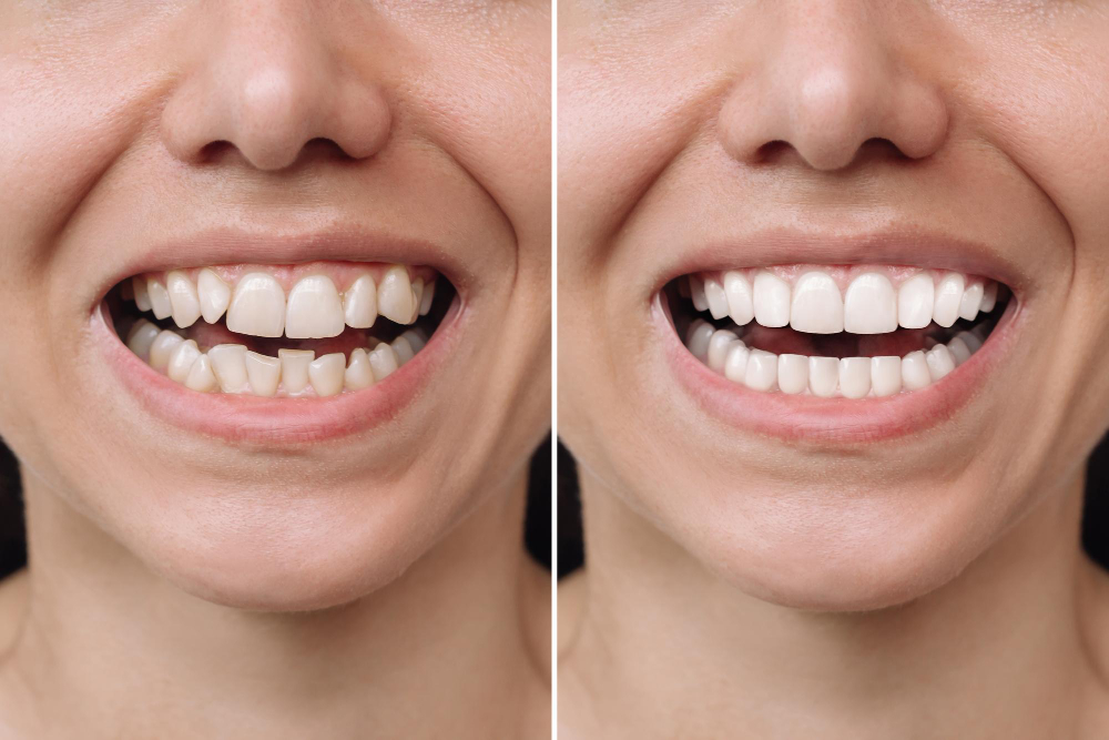before and after porcelain veneers and corrected uneven teeth