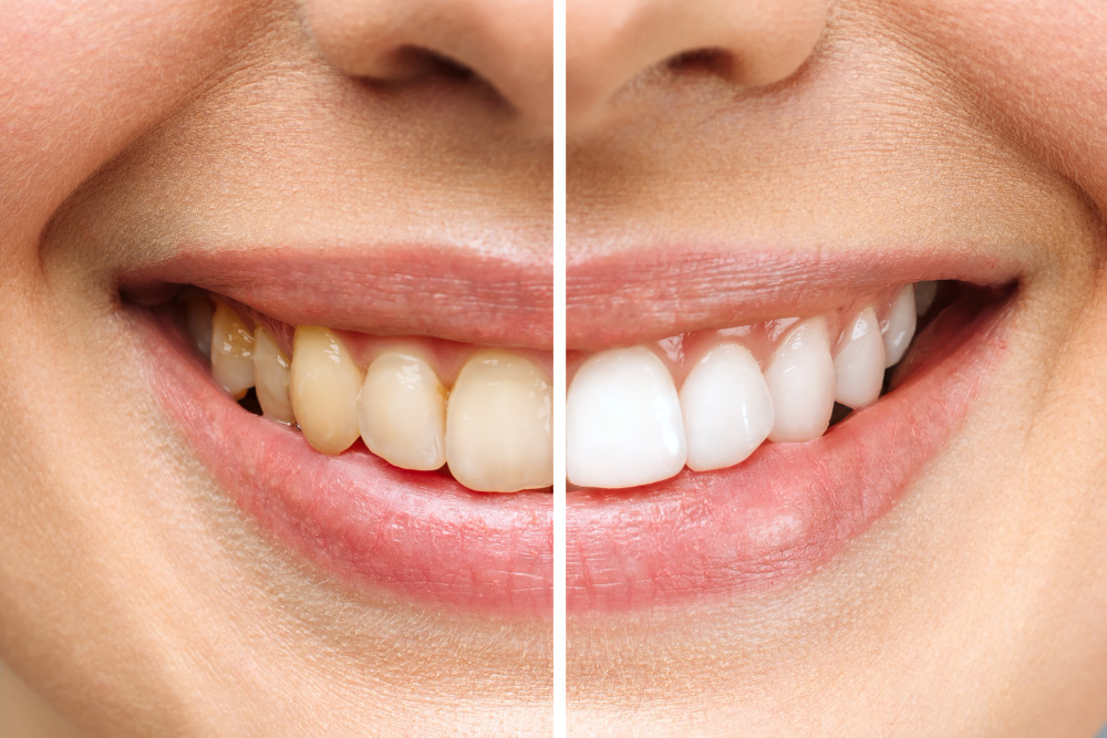 teeth whitening cover image